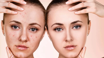 The Top 5 Ways to Get Rid of Acne | Get acne-free Skin