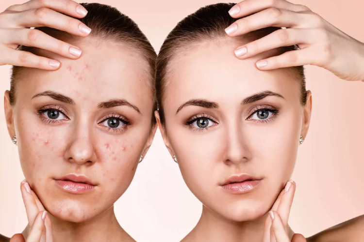 The Top 5 Ways to Get Rid of Acne | Get acne-free Skin