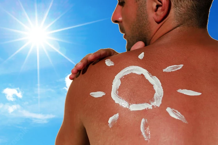 Stay precautious this summer with these sunburn care tips and remedies