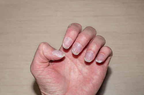 What do your nails say about your health, problem, and treatment