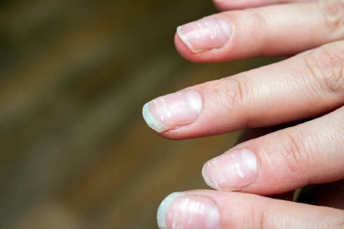 What do your nails say about your health, problem, and treatment