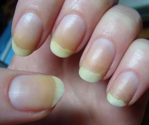 What do your nails say about your health, problem, and treatment