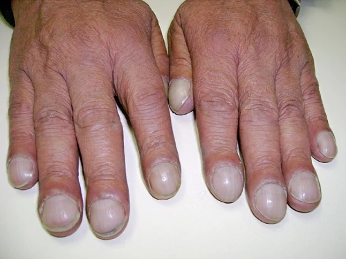 What do your nails say about your health, problem, and treatment