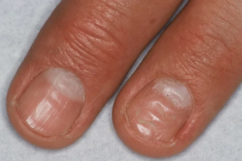 What do your nails say about your health, problem, and treatment